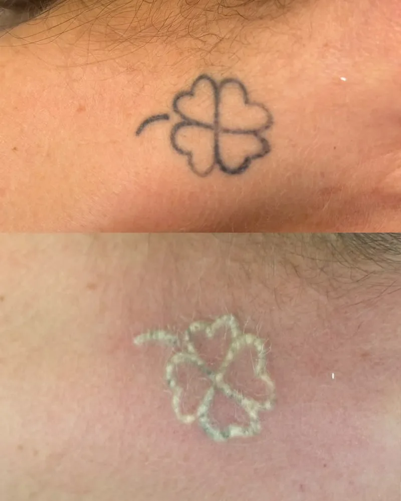 Antes e depois de remoção de tatuagem a laser (1 de 12)