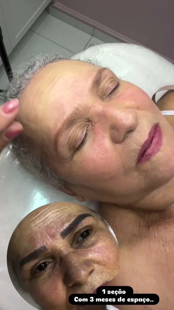 Antes e depois de remoção de micropigmentação a laser (2 de 12)