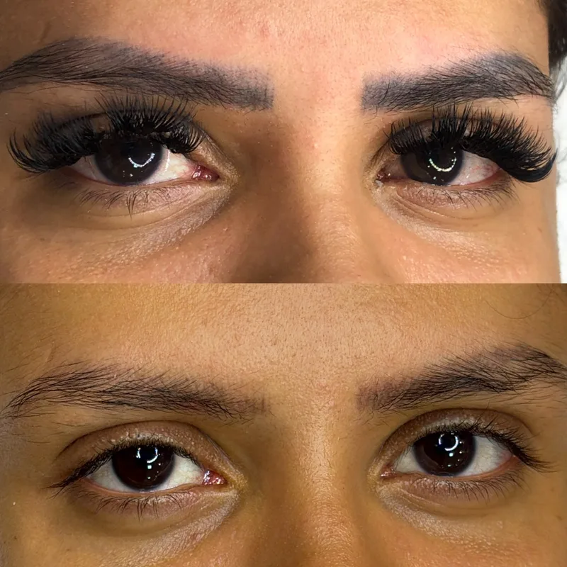 Antes e depois de remoção de micropigmentação a laser (4 de 12)