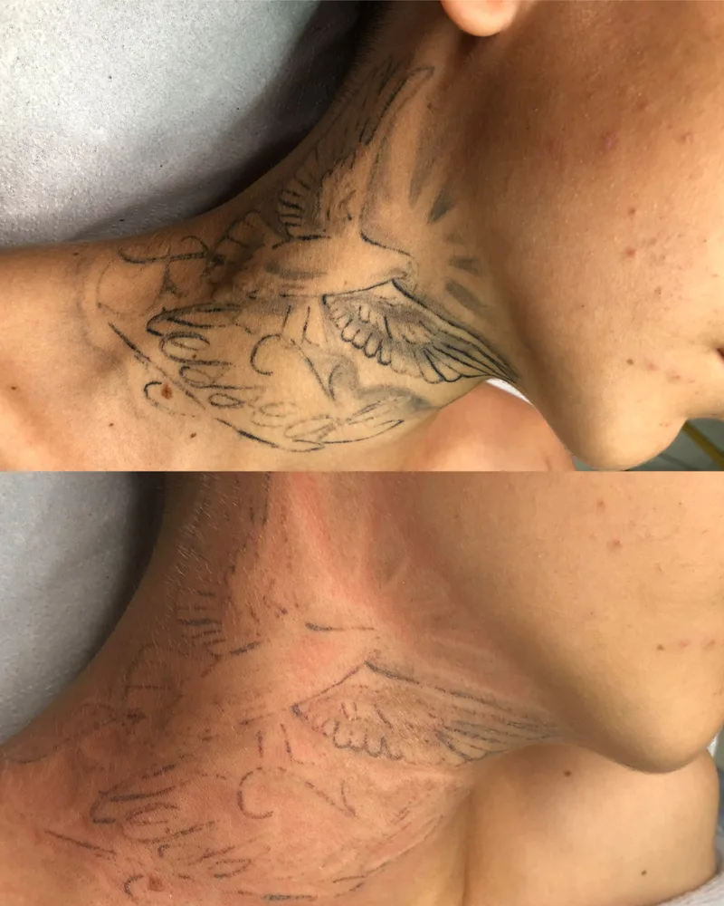 Antes e depois de remoção de tatuagem a laser (5 de 12)