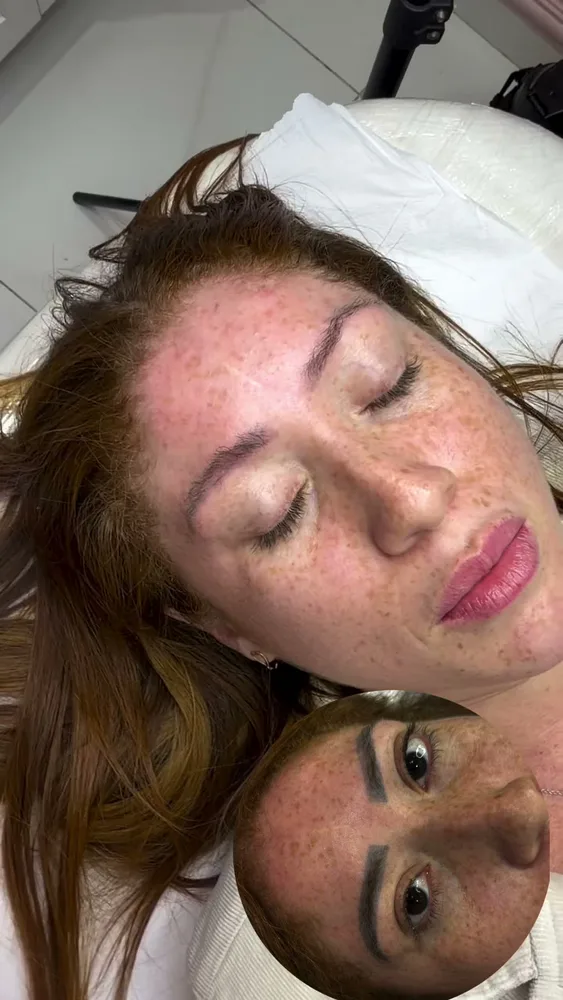 Antes e depois de remoção de micropigmentação a laser (6 de 12)