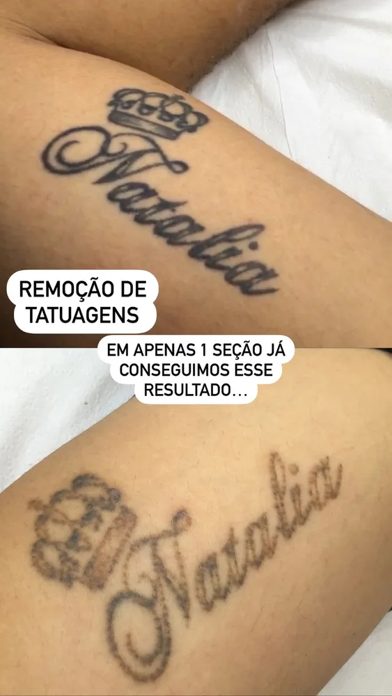 Antes e depois de remoção de tatuagem a laser (7 de 12)