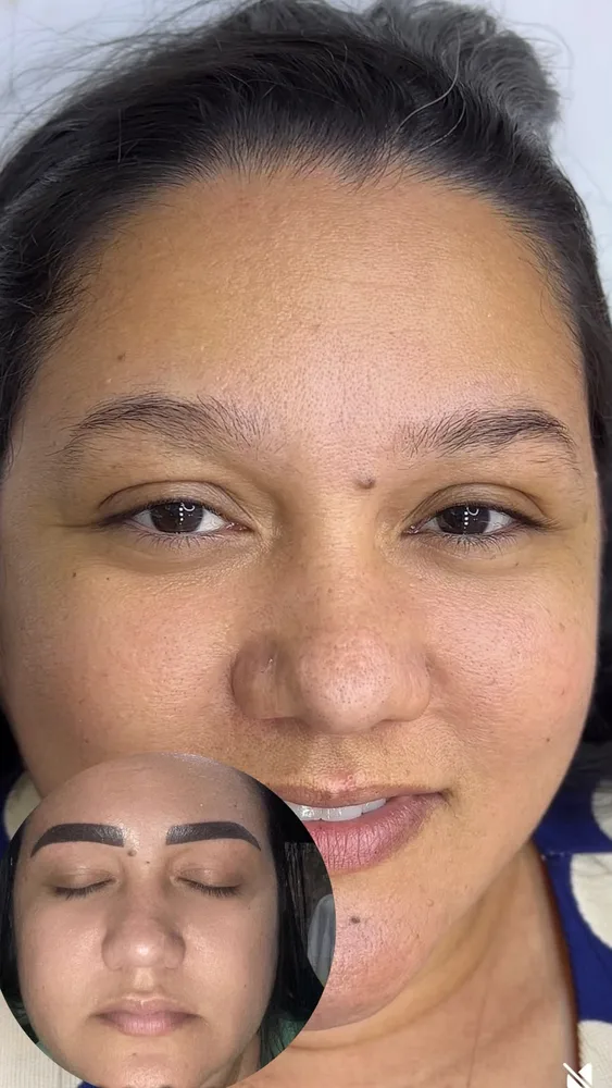 Antes e depois de remoção de micropigmentação a laser (8 de 12)