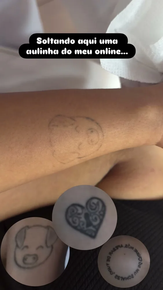 Antes e depois de remoção de tatuagem a laser (9 de 12)