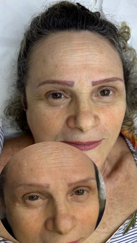 Antes e depois de remoção de micropigmentação a laser (10 de 12)