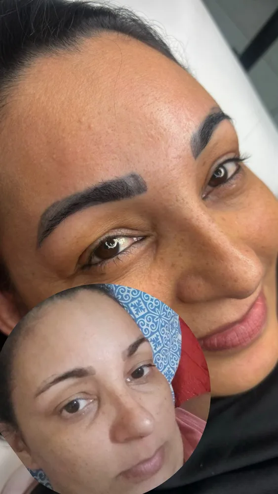 Antes e depois de remoção de micropigmentação a laser (12 de 12)