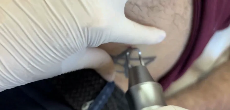 Aula prática: aplicação do laser na remoção de tatuagem